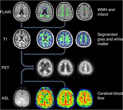 Patterns of Mitochondrial TSPO Binding in Cerebral Small Vessel Disease: An in vivo PET Study With Neuropathological Comparison